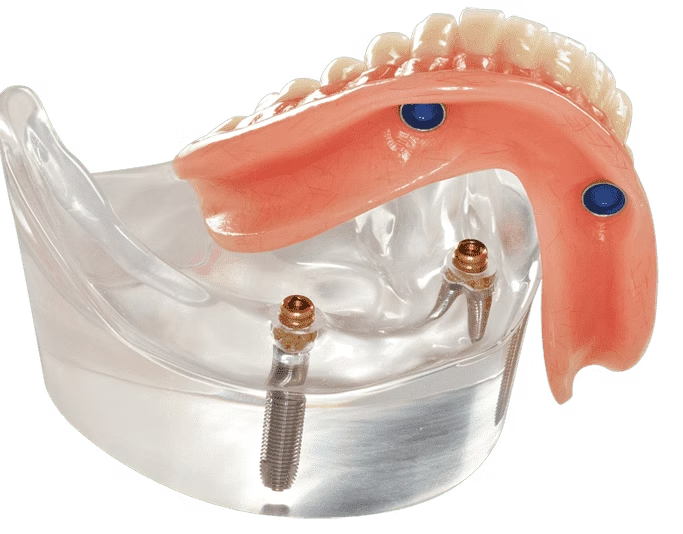 Denture Design Removable Implant Denture Home